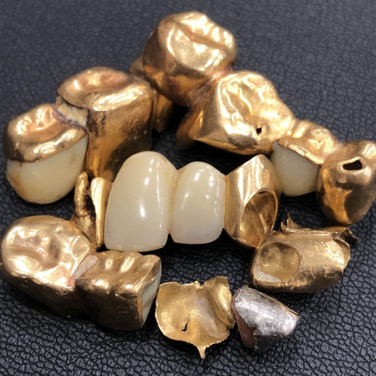 金歯