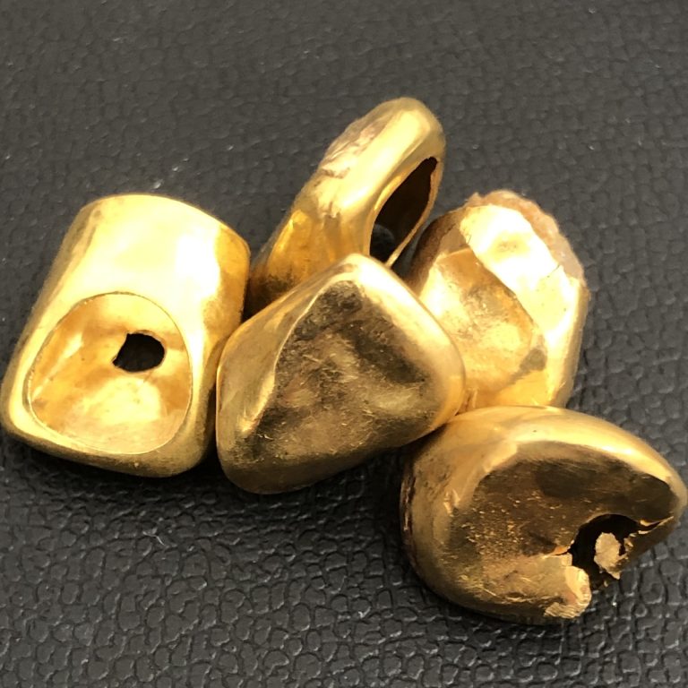 金歯